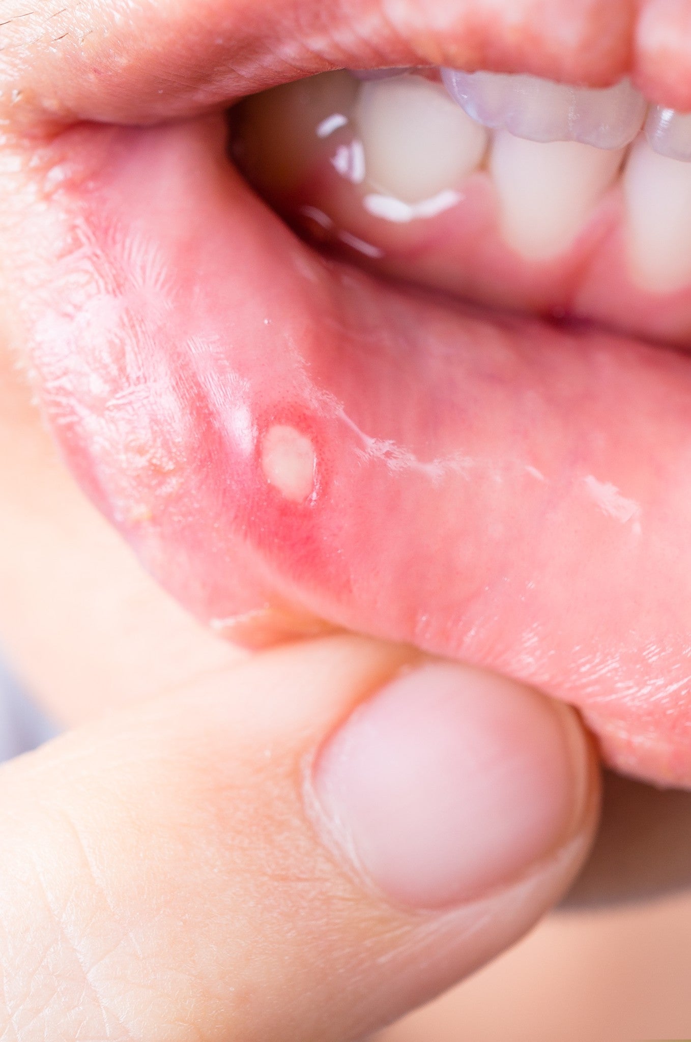 Close up of Asian woman with aphtha on lip